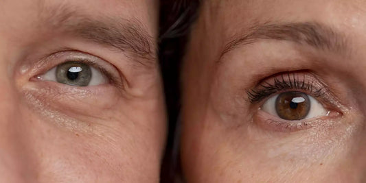 Acide hyaluronique et cernes : le guide complet pour défatiguer le regard