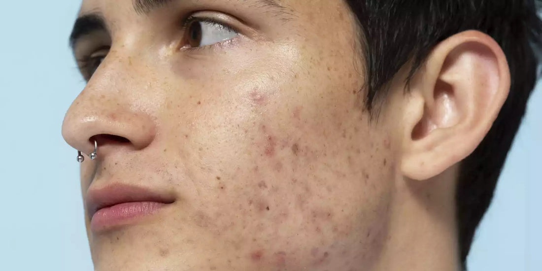 Comment prendre soin d’une peau à imperfections ?