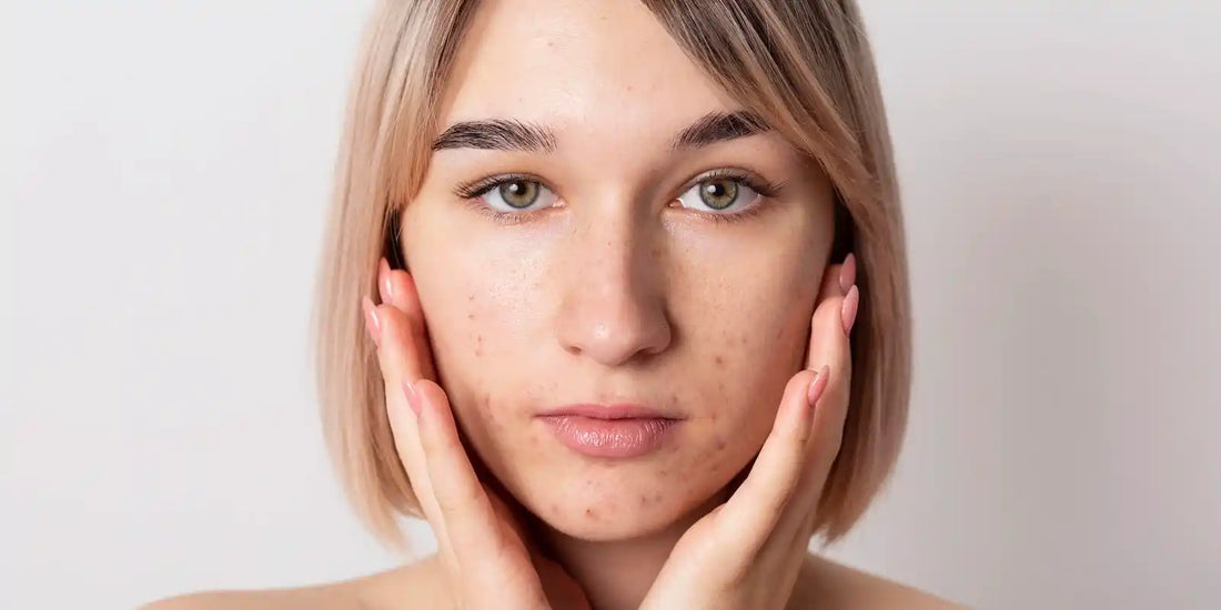 Peau granuleuse sur le visage : Comprendre et traiter les imperfections