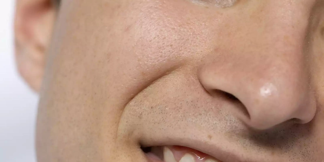 Pores dilatés : comprendre, prévenir et resserrer